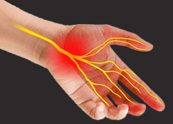 Carpal Tunnel Syndrome